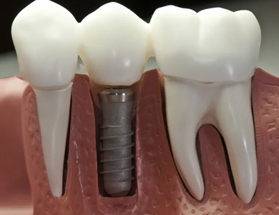 镶嵌牙齿和种植牙齿有什么区别
