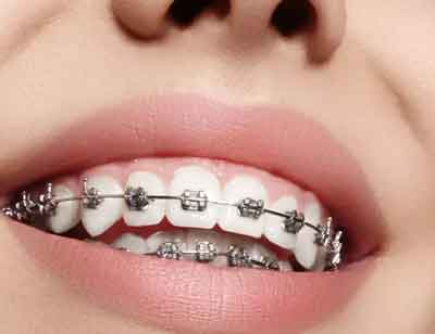 牙齿矫正的年龄限制吗